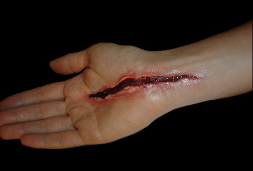 Herida, cicatricure